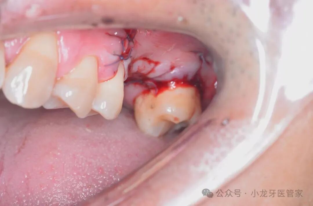 病例分享：上颌窦外提升术一例