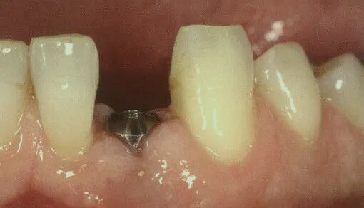 愈合机台怎么识别型号愈合基台的定义、分类、特点和临床选择，一文详解_https://www.jmylbn.com_新闻资讯_第24张