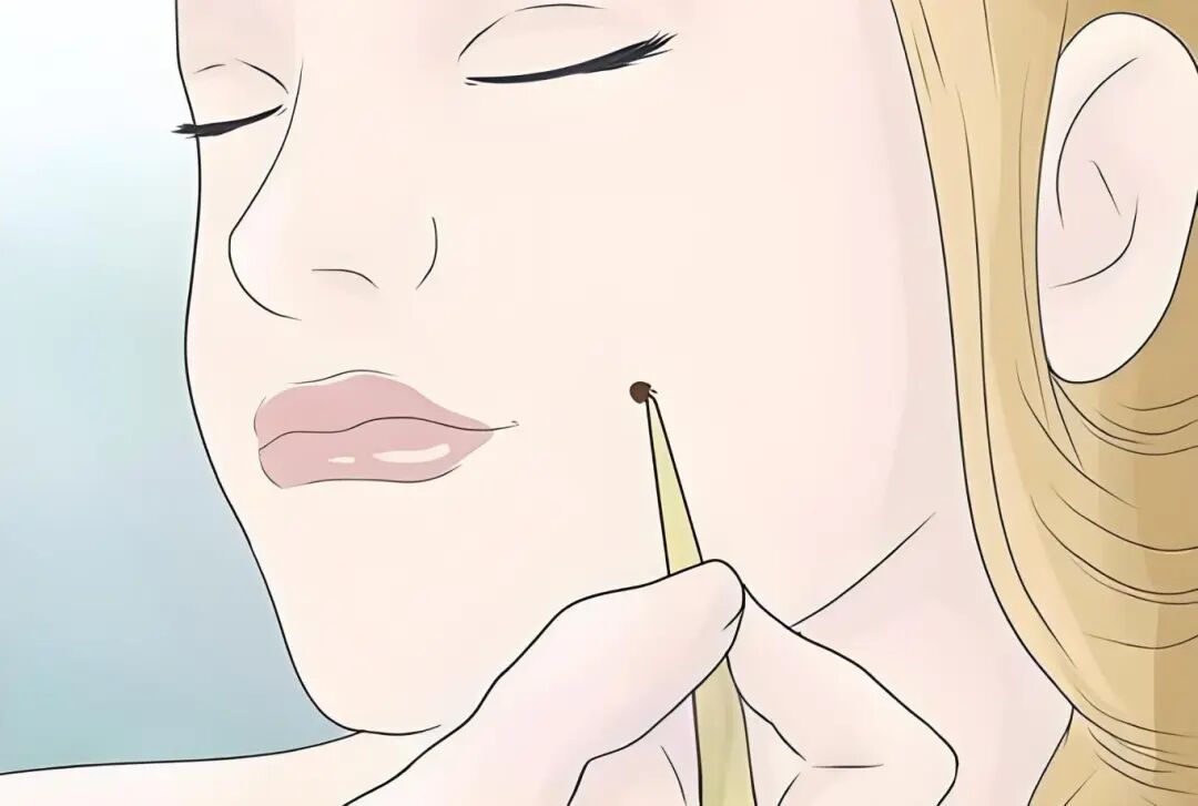 什么是光电治疗光电治疗项目术后要注意这些！_https://www.jmylbn.com_新闻资讯_第7张