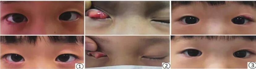 EYESIS强脉冲光治疗儿童霰粒肿案例