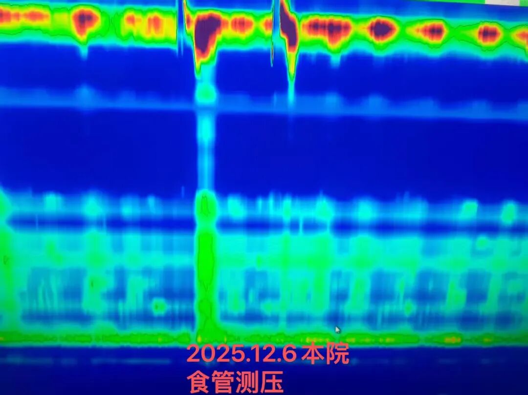 什么是260胃镜小胃镜  大作为——胃镜下食管肌层切开术(POEM)治疗食管贲门失弛缓症_https://www.jmylbn.com_新闻资讯_第2张