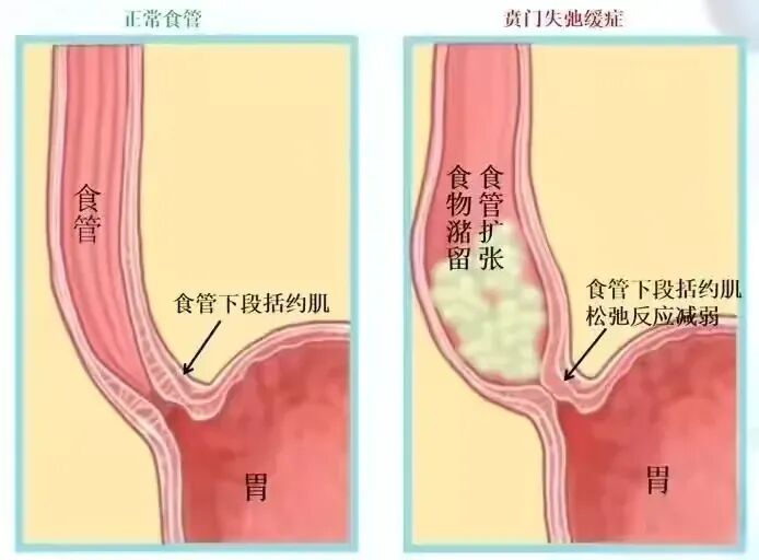 什么是260胃镜小胃镜  大作为——胃镜下食管肌层切开术(POEM)治疗食管贲门失弛缓症_https://www.jmylbn.com_新闻资讯_第4张
