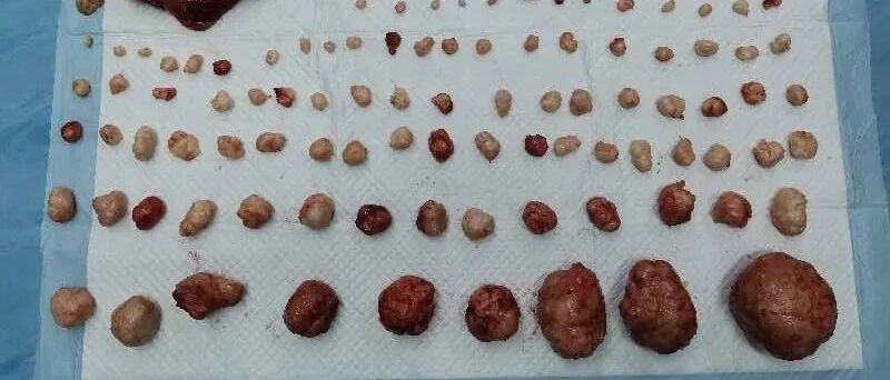 罕见！120多个子宫肌瘤，最大达6斤！患了这种病的女士在饮食上要注意