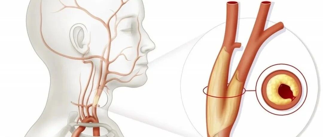 颈动脉斑块的那些事