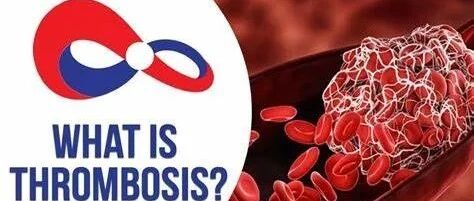 【世界血栓日】这些人最易被血栓“拴住”，四大早期信号你知道吗？