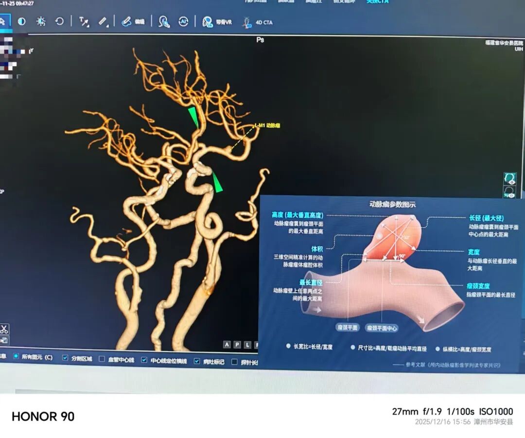 联影有哪些CT我院放射科再添“硬核“利器—联影60排120层螺旋CT机_https://www.jmylbn.com_新闻资讯_第20张
