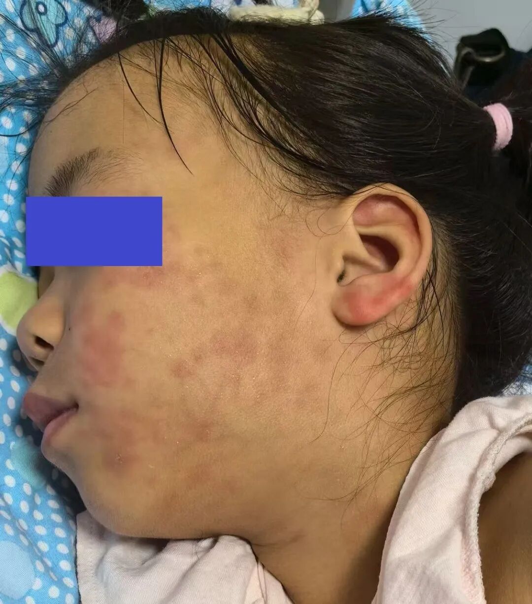  疫情的症状和表现图片大全高清(疫情的症状和表现图片大全高清图)