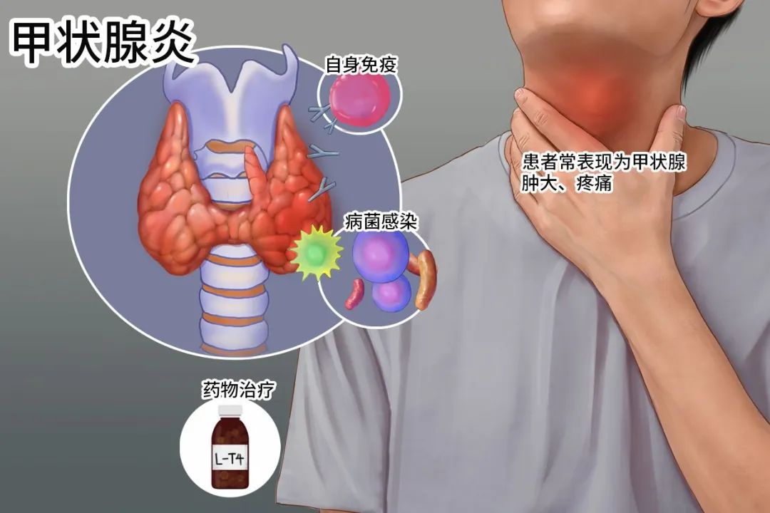 性甲状腺炎、产后甲状腺炎等；少数为感染导致的暂时性甲状腺炎症引致。