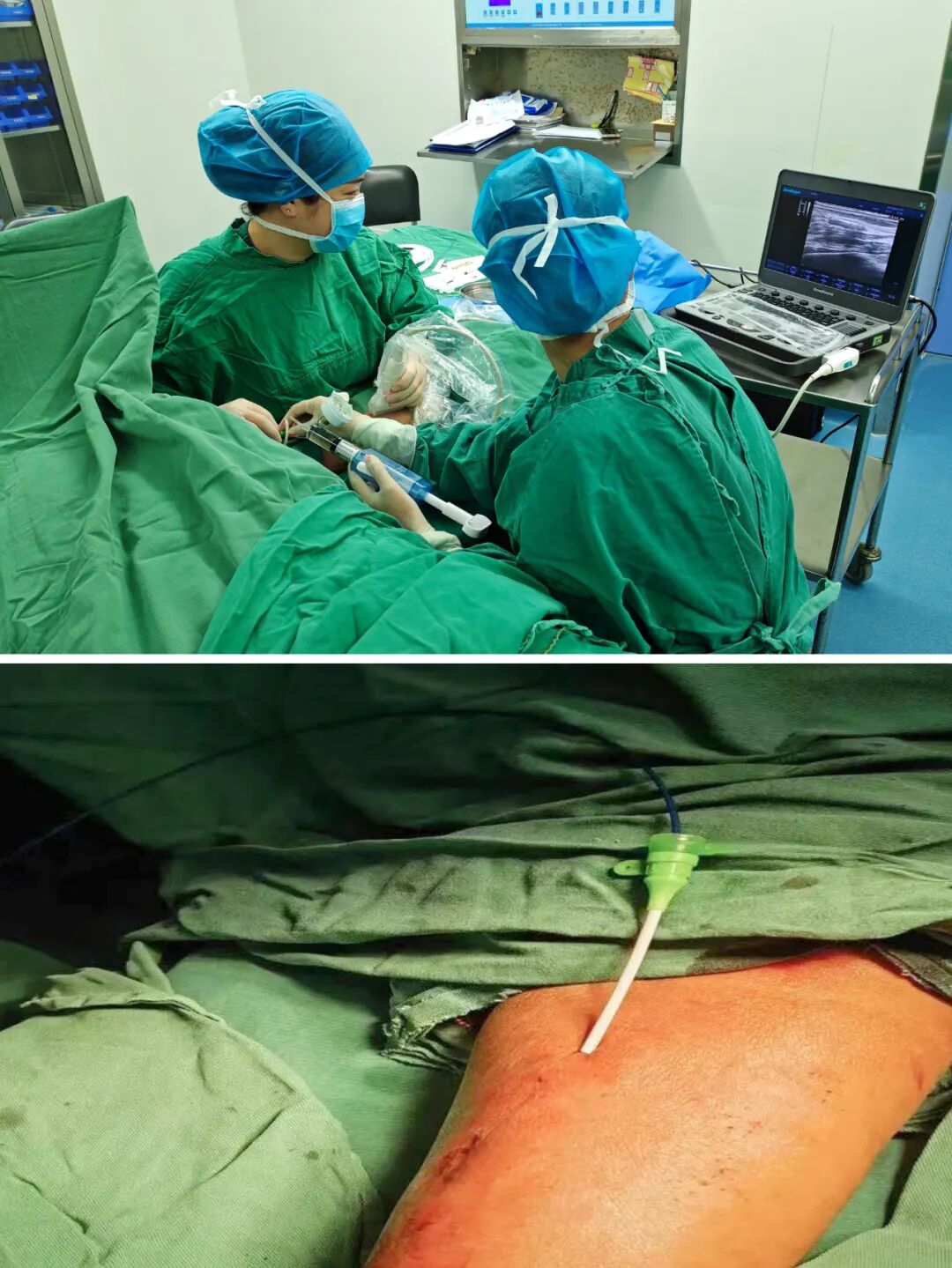思南县民族中医院:成功开展县域内首例动静脉内瘘球囊扩张术