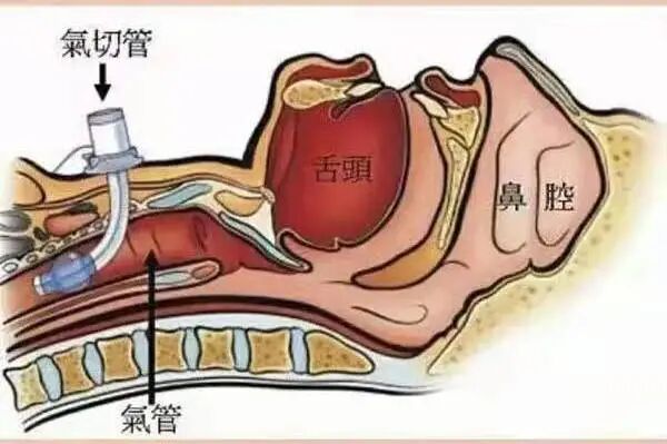 为什么要购买呼吸机气切患者为什么要重视气道湿化？_https://www.jmylbn.com_新闻资讯_第5张