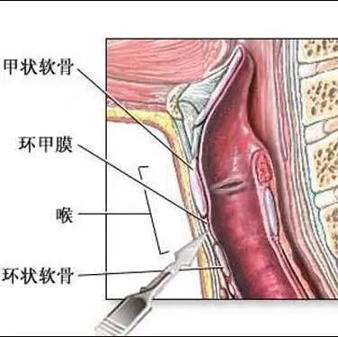 气管套管怎么换药专业级护理指南丨气切后应该如何换药？_https://www.jmylbn.com_新闻资讯_第8张