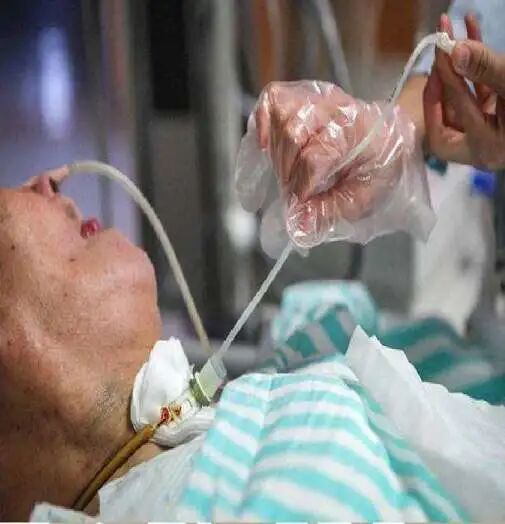 吸痰管怎么用气管切开患者该如何吸痰？_https://www.jmylbn.com_新闻资讯_第9张