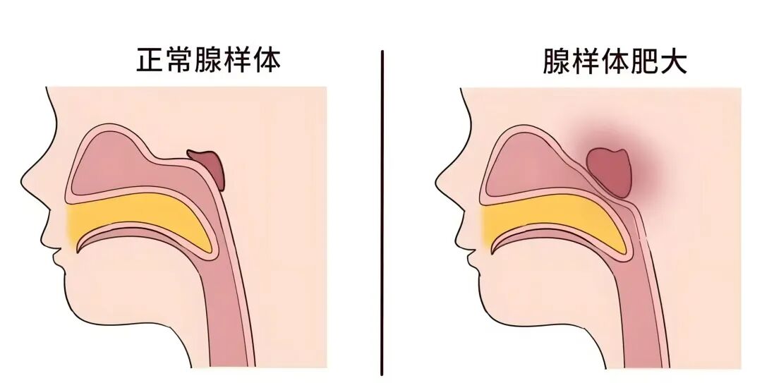 什么是等离子治疗仪【低温微创 · 优势治疗】低温等离子治疗仪，五官科疾病的“高级武器”_https://www.jmylbn.com_新闻资讯_第10张