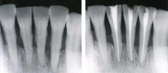 根充需要哪些器械【根管治疗】根管治疗操作规范_https://www.jmylbn.com_新闻资讯_第1张