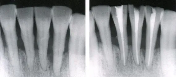根充需要哪些器械【根管治疗】根管治疗操作规范_新闻资讯_第1张_活检穿刺产品网 根充需要哪些器械【根管治疗】根管治疗操作规范_https://www.jmylbn.com_新闻资讯_第1张