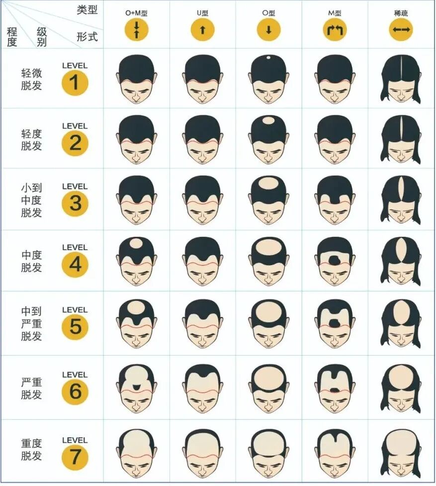 对照这张脱发等级图，看看你是几级脱发