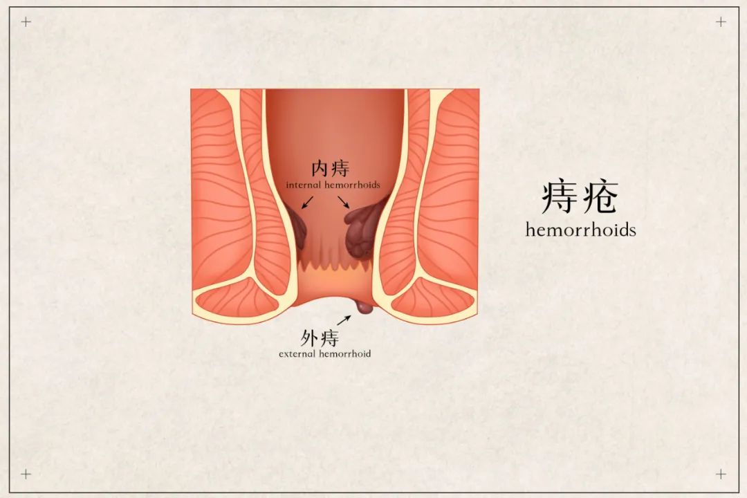 柳州东大肛肠医院:肛门口长了肉球,怎样才能消除?