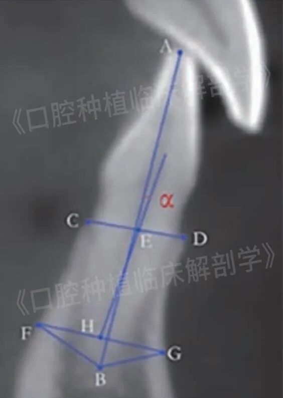 前牙区局部即刻种植解剖