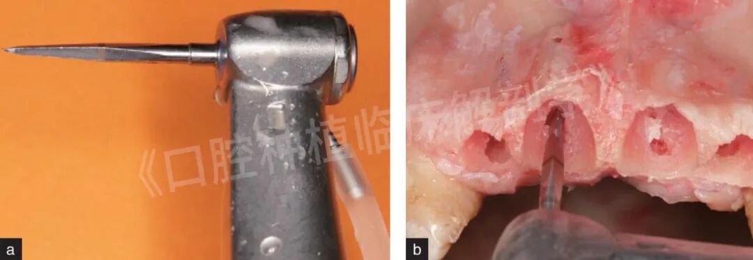 前牙区局部即刻种植解剖