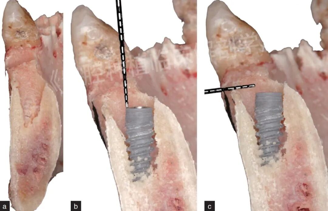 前牙区局部即刻种植解剖