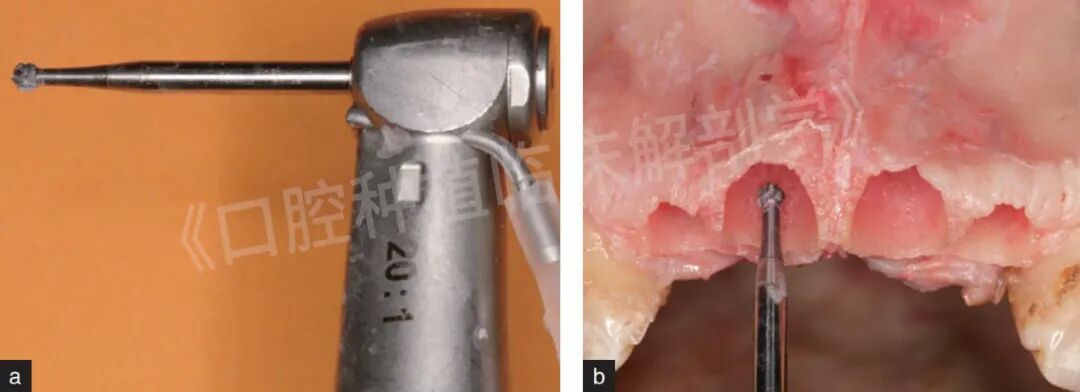 前牙区局部即刻种植解剖