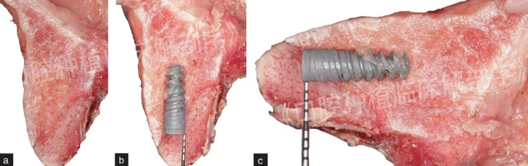 前牙区局部即刻种植解剖