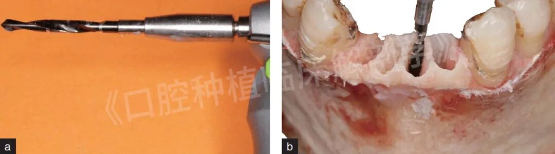 前牙区局部即刻种植解剖