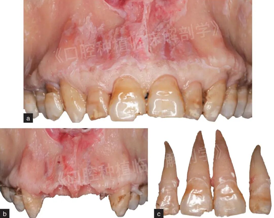 前牙区局部即刻种植解剖