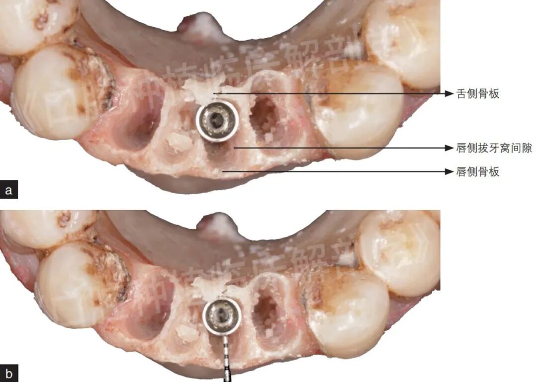 前牙区局部即刻种植解剖