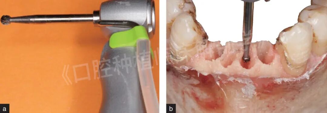 前牙区局部即刻种植解剖