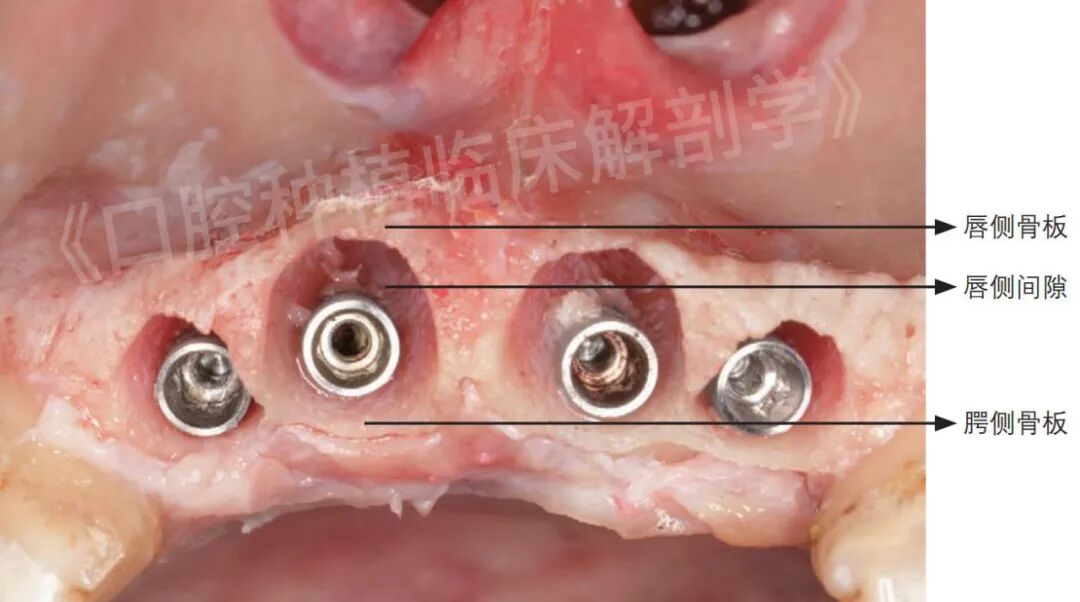 前牙区局部即刻种植解剖