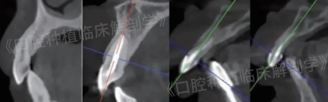 前牙区局部即刻种植解剖