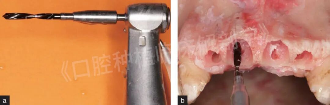 前牙区局部即刻种植解剖