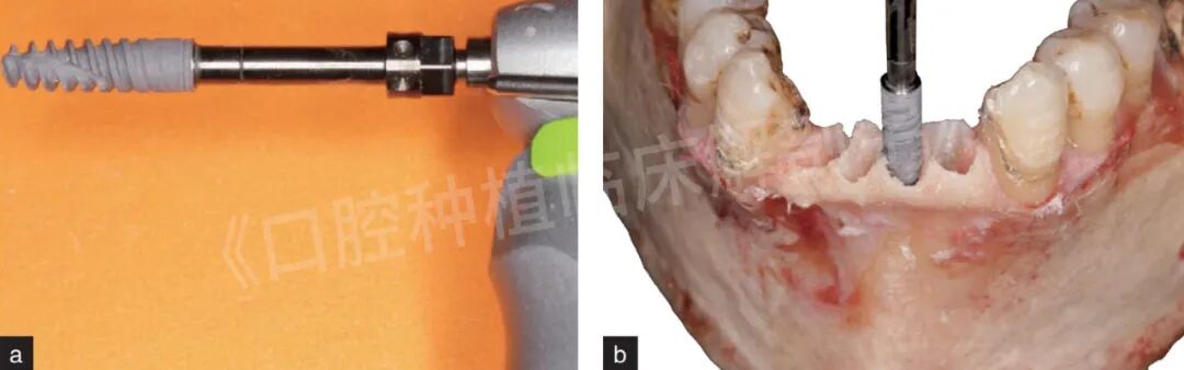 前牙区局部即刻种植解剖