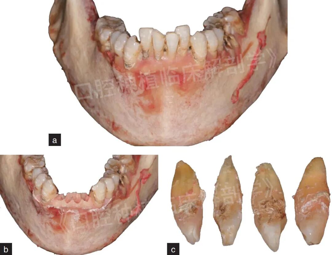 前牙区局部即刻种植解剖