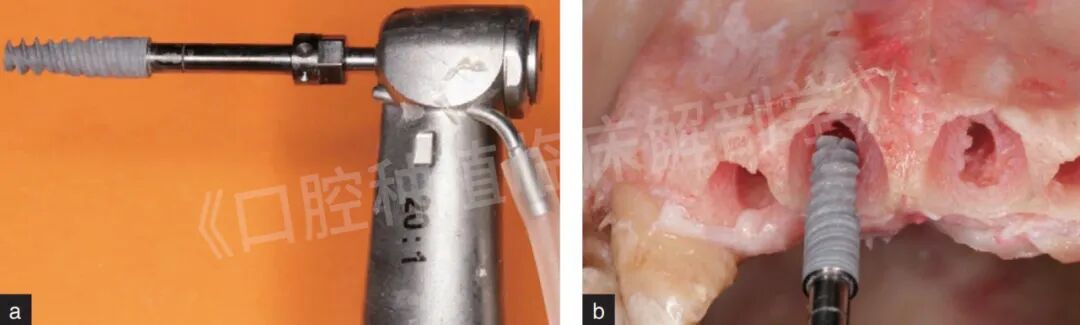 前牙区局部即刻种植解剖