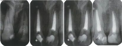 根管马达怎么修根管内器械分离的影响因素_https://www.jmylbn.com_新闻资讯_第4张