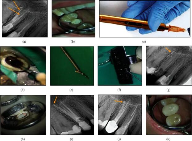 取针钳怎么使用器械折断莫慌！教你4种取断针的方法_https://www.jmylbn.com_新闻资讯_第5张