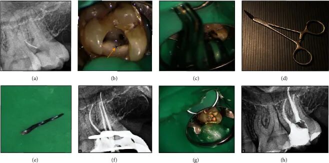 取针钳怎么使用器械折断莫慌！教你4种取断针的方法_https://www.jmylbn.com_新闻资讯_第7张