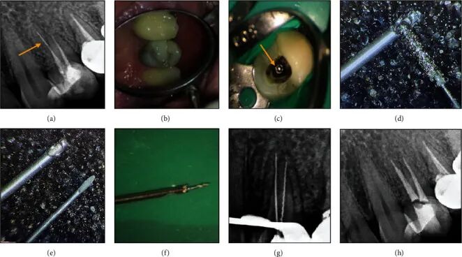 取针钳怎么使用器械折断莫慌！教你4种取断针的方法_https://www.jmylbn.com_新闻资讯_第6张