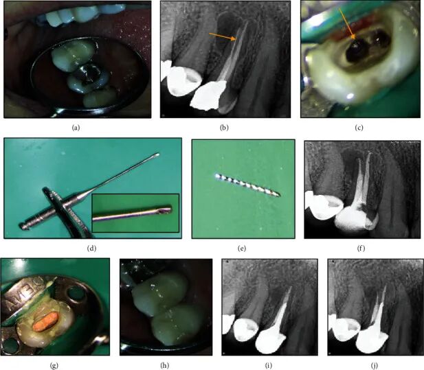 取针钳怎么使用器械折断莫慌！教你4种取断针的方法_https://www.jmylbn.com_新闻资讯_第4张