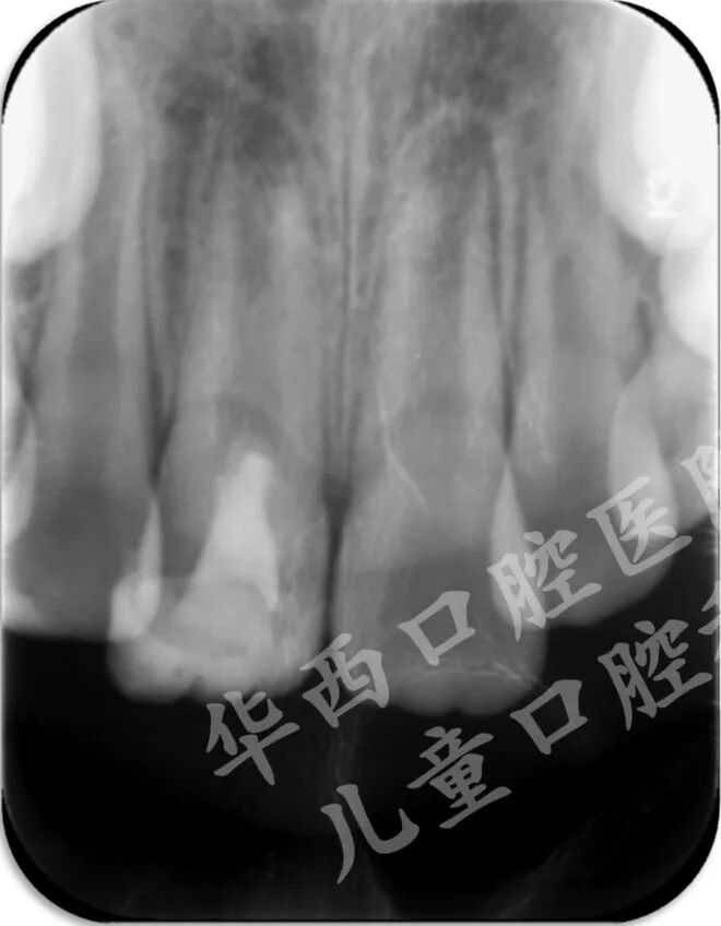 年轻恒牙冠折露髓的牙髓切断术病例解析 | 周昕博士 邹静教授-搜博
