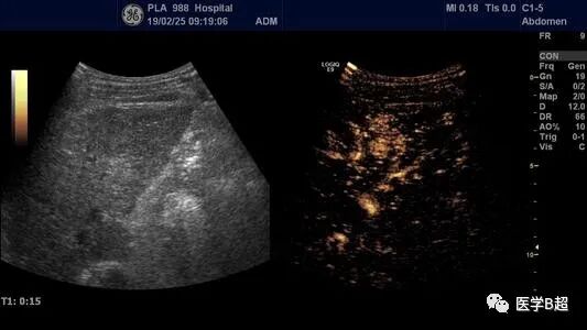 b超md是什么意思肝脏B超报告单常见术语全在这里！_https://www.jmylbn.com_新闻资讯_第5张