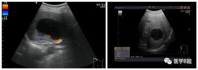 b超md是什么意思肝脏B超报告单常见术语全在这里！_https://www.jmylbn.com_新闻资讯_第4张