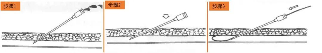 导管鞘怎么念导管鞘的介绍_https://www.jmylbn.com_新闻资讯_第6张