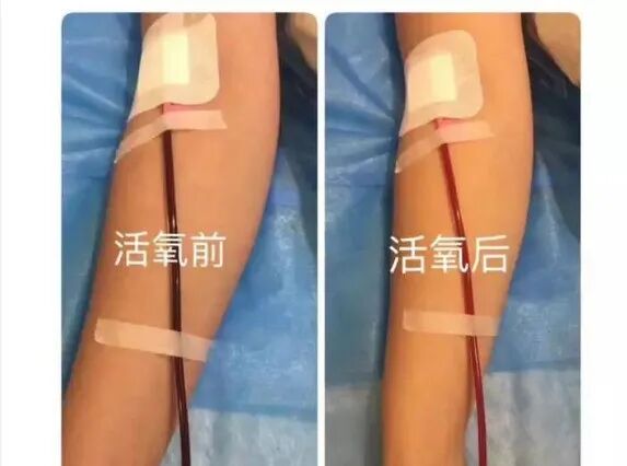 什么是臭氧大自血疗法“三氧大自血疗法”对下静脉血栓性疾病的治疗案例分享_https://www.jmylbn.com_新闻资讯_第3张