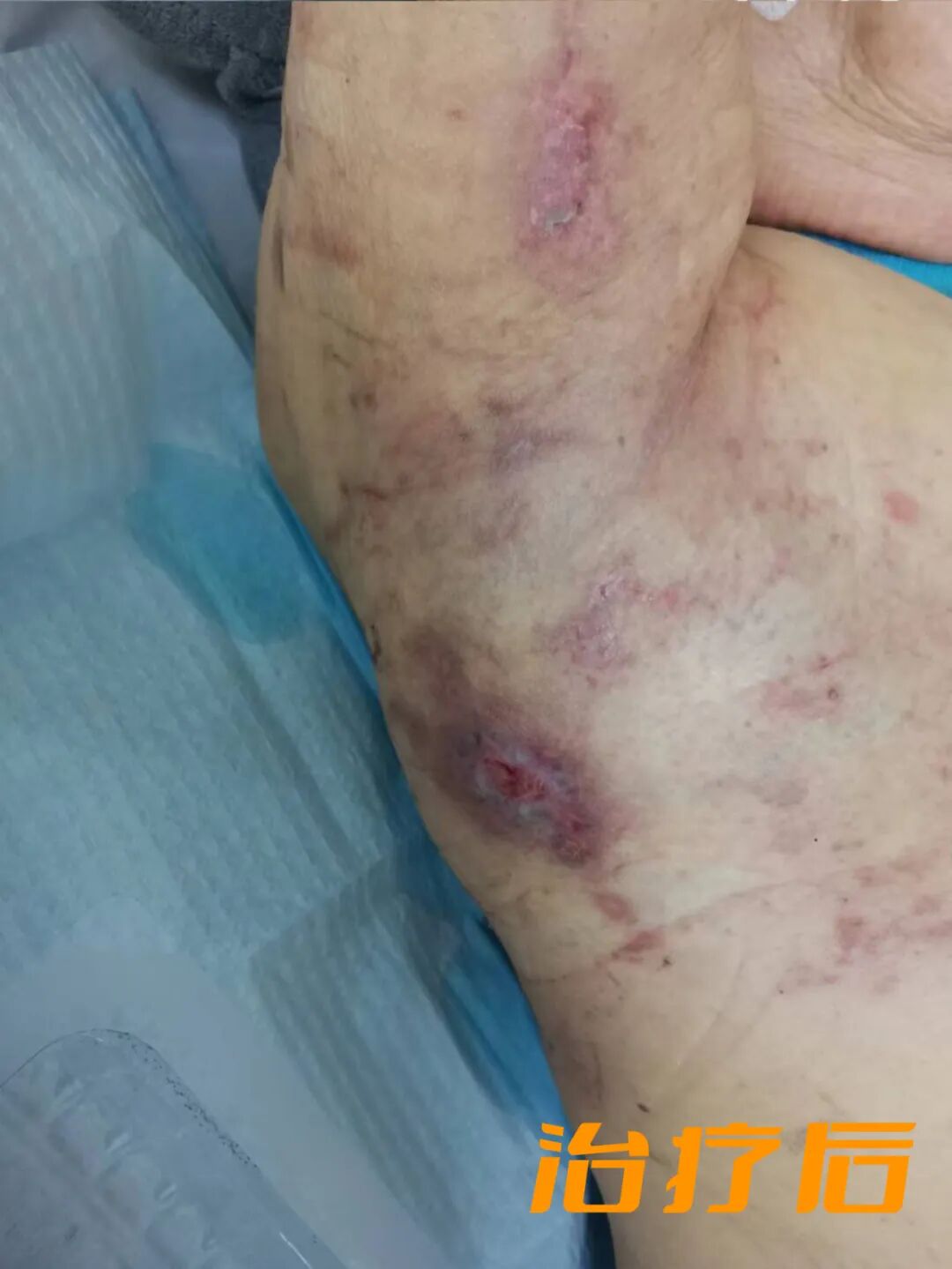 vsd引流怎么拔出VSD负压引流术，助压疮患者摆脱痛苦_https://www.jmylbn.com_新闻资讯_第10张