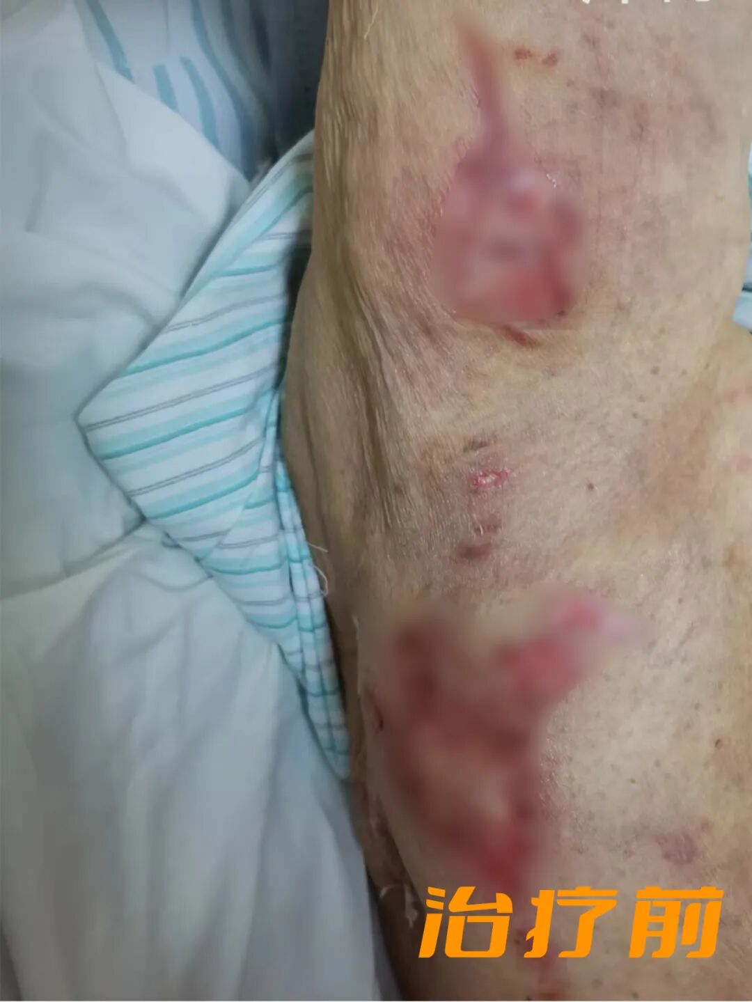 vsd引流怎么拔出VSD负压引流术，助压疮患者摆脱痛苦_https://www.jmylbn.com_新闻资讯_第9张