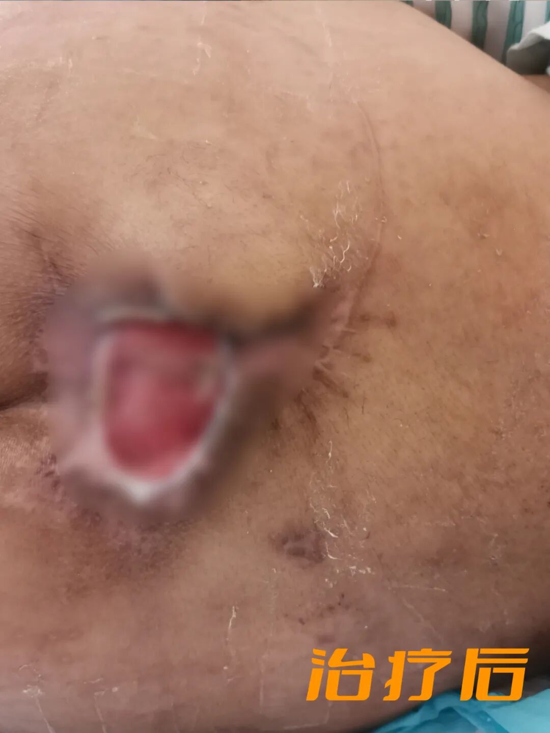 vsd引流怎么拔出VSD负压引流术，助压疮患者摆脱痛苦_https://www.jmylbn.com_新闻资讯_第8张