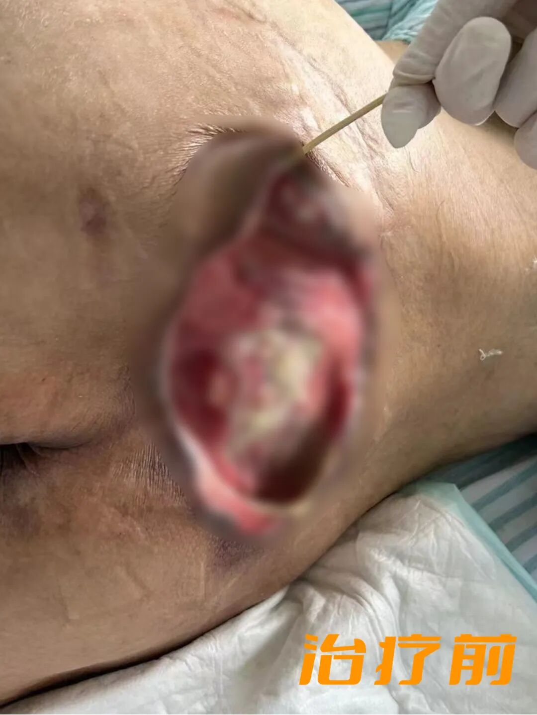 vsd引流怎么拔出VSD负压引流术，助压疮患者摆脱痛苦_https://www.jmylbn.com_新闻资讯_第7张